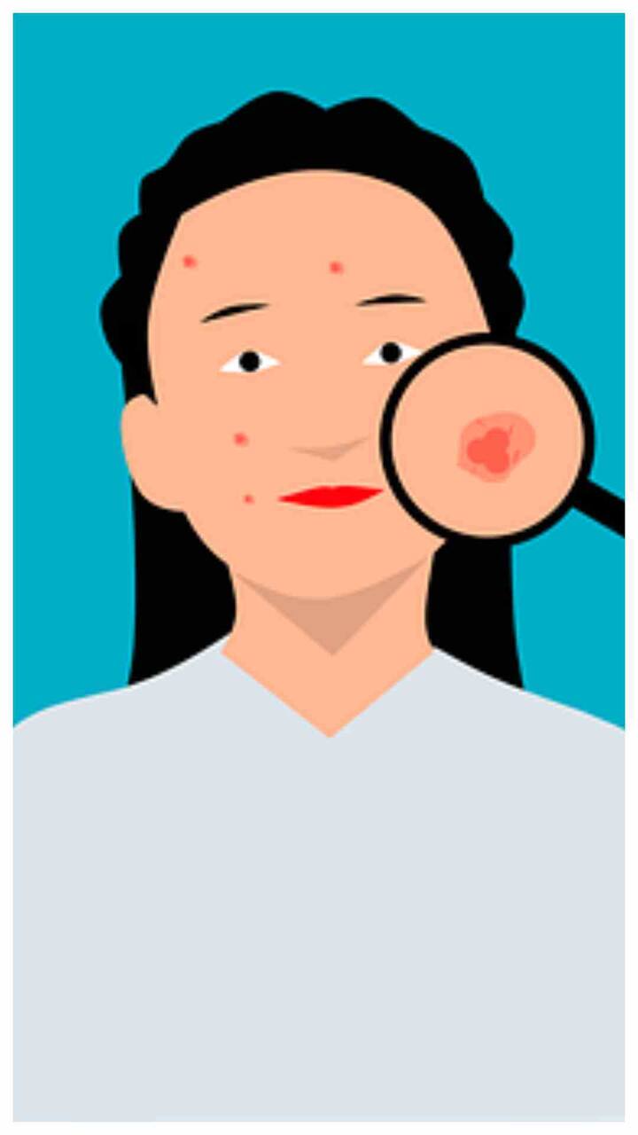स्किन से पिंपल्स और एक्ने की परेशानी कम करने के लिए सप्ताह में दो बार मुल्तानी मिट्टी लगाएं. इससे चेहरे की खूबसूरती बढ़ती है. (Photo - Freepik)