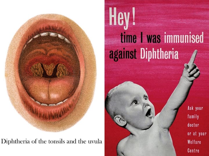Throat Diphtheria symptoms causes Australia NSW Detects 2 Cases First Time After 1990s know precautions What Is Throat Diphtheria? Australia’s NSW Detects 2 Cases First Time After 1990s. Know Symptoms, Causes, How To Prevent