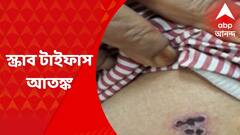 Scrub Typhus : ফিরল স্ক্রাব টাইফাস আতঙ্ক, কলকাতায় আক্রান্ত বেশ কয়েকজন