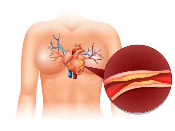 High Cholesterol: कोलेस्ट्रॉल बढ़ने पर क्या न खाएं? एक क्लिक में जान लीजिए लिस्ट High Cholesterol: कोलेस्ट्रॉल बढ़ने पर क्या न खाएं? एक क्लिक में जान लीजिए लिस्ट