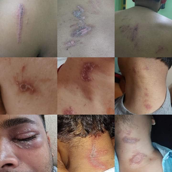 Nairobi Flies Infect Sikkim Students: All You Need To Know About Skin-Burning Insects Nairobi Flies : பரபரப்பு.. நைரோபி பூச்சிகள்.. சிக்கிம் மாணவர்களை பாதித்த விநோத ஆசிட் பூச்சிகள்.. இதைப்பத்தி தெரியுமா?