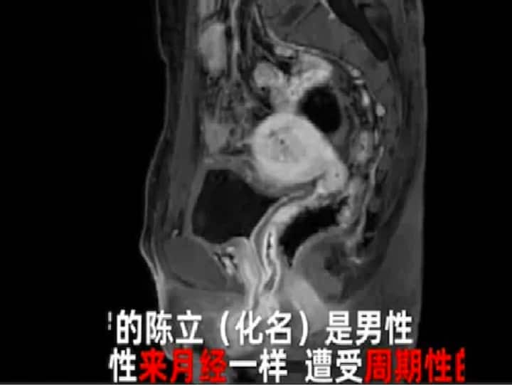 Chinese Man Who Complained of Blood in Urine Discovers He Has Ovaries, Uterus சிறுநீரில் ரத்தம் வருவதாக, மருத்துவமனைக்கு சென்றவருக்கு காத்திருந்த அதிர்ச்சி.. பதறிய மருத்துவர்கள்..