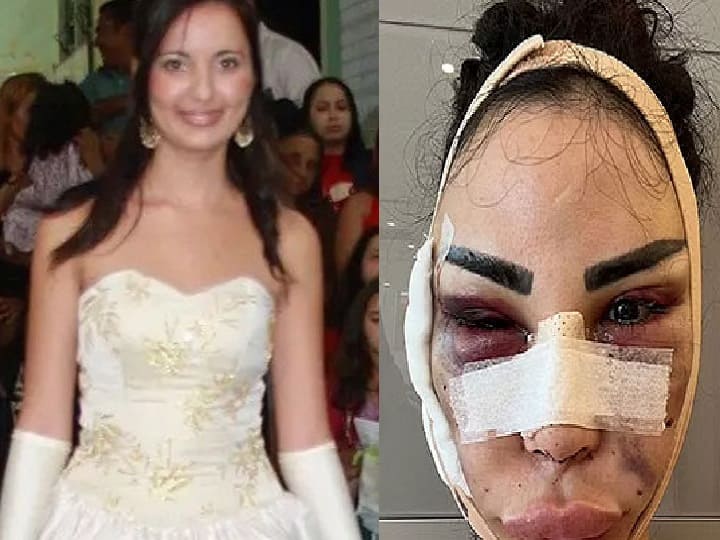 USA Woman spent 4 crore to be Kim Kardashian, now paying 95 lakhs to detransition சொந்தக்காசில் சூனியம்! 'கிம்'போல மாற 40 ஆபரேஷன்! ரூ.4 கோடி செலவு செய்து சிக்கலில் மாட்டிய பெண்!