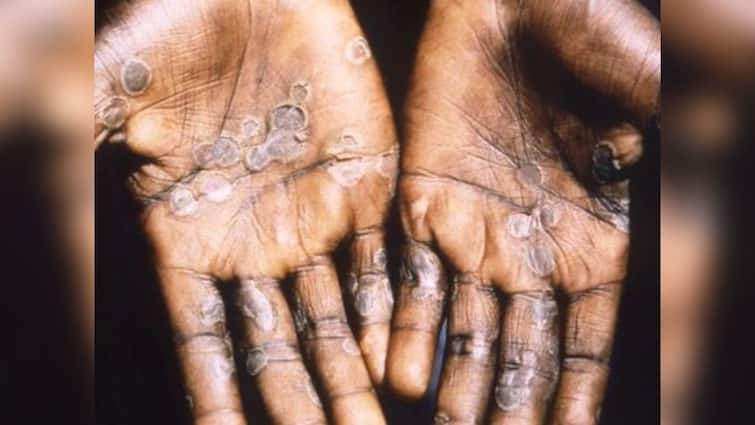 Monkeypox Case in India Confirmed By Kerala Health Minister Patient Recently Returned From UAE Monkeypox: মাঙ্কিপক্সের হানা ভারতে! কেরলে খোঁজ মিলল প্রথম আক্রান্তের