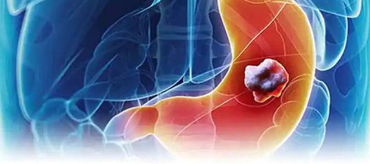Stomach Cancer: Don't ignore these symptoms in the stomach, otherwise it can have a bad effect on health. Stomach Cancer : ਪੇਟ 'ਚ ਦਿਖਾਈ ਦੇਣ ਵਾਲੇ ਇਨ੍ਹਾਂ ਲੱਛਣਾਂ ਨੂੰ ਨਾ ਕਰੋ ਨਜ਼ਰਅੰਦਾਜ਼, ਨਹੀਂ ਤਾਂ ਸਿਹਤ 'ਤੇ ਪੈ ਸਕਦਾ ਹੈ ਬੁਰਾ ਪ੍ਰਭਾਵ