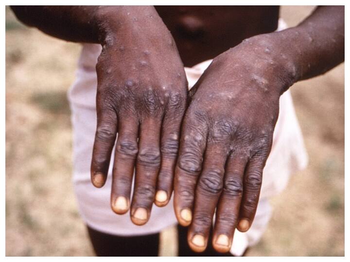 Kerala Reports India's First Monkeypox Case, Minister Says UAE Returnee Stable Kerala Reports India's First Monkeypox Case, Minister Says UAE Returnee Stable Kerala Reports India's First Monkeypox Case, Minister Says UAE Returnee Stable