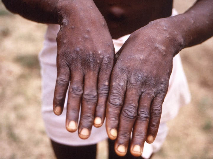 Monkeypox News India's first Monkeypox case reported in Kerala Monkeypox In India: ભારતમાં મંકીપોક્સ વાયરસનો પ્રથમ કેસ,  UAEથી કેરળ પરત ફરેલો એક વ્યક્તિ થયો સંક્રમિત