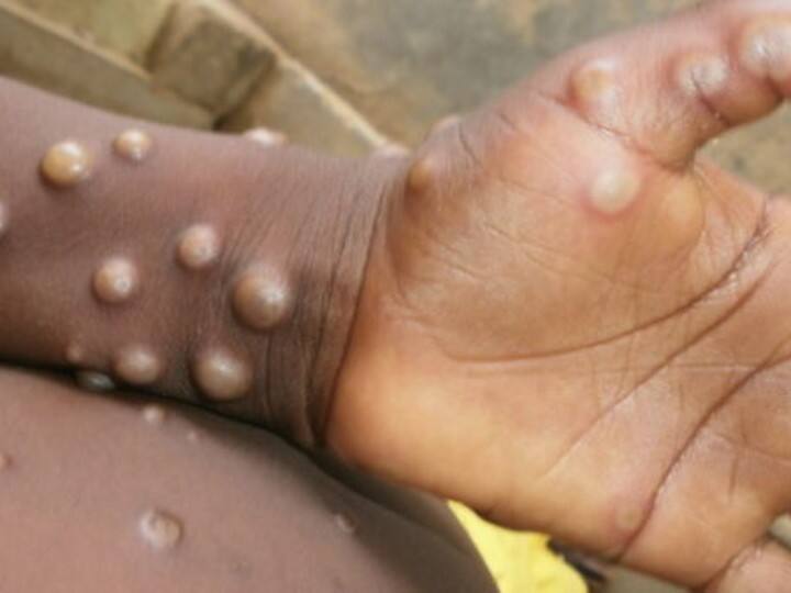 Monkeypox Case in India Confirmed By Kerala Health Minister Patient Recently Returned From UAE Monkeypox Case in India: ஐக்கிய அமீரகத்தில் இருந்து வந்த நபருக்கு குரங்கு அம்மை: கேரளா விரையும் மத்தியக் குழு
