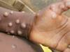 Monkeypox Case in India: ஐக்கிய அமீரகத்தில் இருந்து வந்த நபருக்கு குரங்கு அம்மை: கேரளா விரையும் மத்தியக் குழு