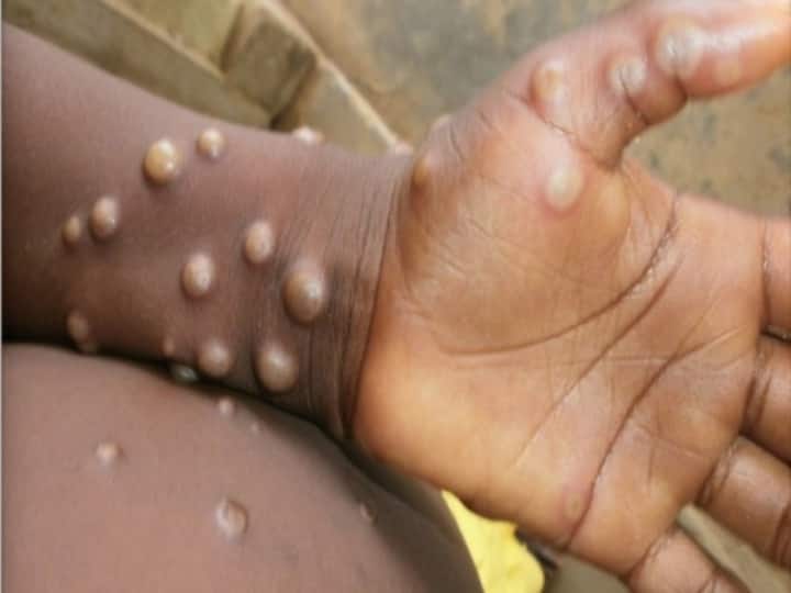 Monkeypox is spreading all over the world, but its speed is not as fast as Corona