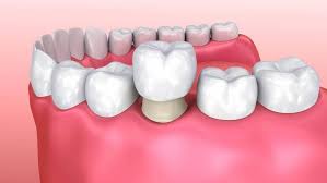 Turkey Teeth: ஆபத்துகள் நிறைந்த பற்களை அழகாக்கும் சிகிச்சைகள்! எச்சரிக்கும் மருத்துவர்கள்!