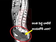 Bottel in Bowels: అంత పెద్ద బాటిల్‌ అందులోకి ఎలా వెళ్లిందయ్యా? కారణం తెలిసి షాకైన వైద్యులు!
