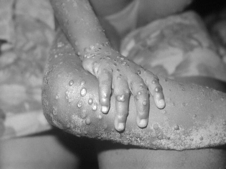 Explained: Monkeypox is a health emergency but why is it not as dangerous as corona, understand in 5 points Explained: મંકીપોક્સ એ હેલ્થ ઈમરજન્સી છે પરંતુ તે કોરોના જેટલો ખતરનાક નથી, સમજો આ 5 પોઈન્ટમાં