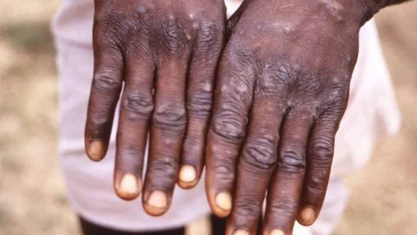 MonkeyPox in Kerala: குரங்கு அம்மையை குறைக்க இதை செய்யுங்க: மத்திய அரசு அறிவுறுத்தல் Monkeypox centre instructs to go with strict screening for passengers MonkeyPox in Kerala: குரங்கு அம்மையை குறைக்க இதை செய்யுங்க: மத்திய அரசு அறிவுறுத்தல்