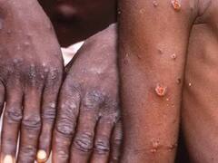Monkeypox Case in Kannur: கேரளாவில் மேலும் ஒருவருக்கு குரங்கு அம்மை!