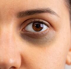 આંખોની નીચે ડાર્ક સર્કલ  આપના સ્કિન ટોનને બગાડે છે, કેટલાક સરળ  ઉપાયથી તેને દૂર કરી શકાય છે.