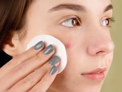 Hyperpigmentation: మొటిమలతో విసిగిపోయారా? ఈ ఇంటి చిట్కాలు పాటిస్తే ఇట్టే తగ్గిపోతాయి