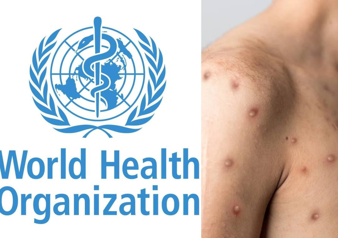 Monkeypox Outbreak WHO Reports 14000 Monkeypox Cases globally Five Deaths In Africa Monkeypox Outbreak: குரங்கு அம்மையால் இத்தனை ஆயிரம் பேருக்கு பாதிப்பு? இவ்வளவு உயிரிழப்பு.. பகீர் கிளப்பும் தரவுகள்..