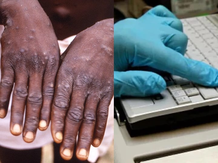 Monkeypox 95 Per Cent Cases Transmitted Through Sexual Activity Who New England Journal of Medicine Study Monkeypox: क्या यौन संपर्क से तेजी से फैल रहा है मंकीपॉक्स? स्टडी में चौंकाने वाला खुलासा