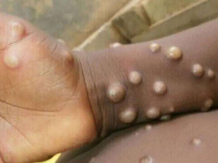 Monkeypox Virus India: கேரளாவில் அதிகரிக்கும் குரங்கு அம்மை! எண்ணிக்கை 3ஆக அதிகரிப்பு!! Monkeypox Virus Cases India Third Case Confirmed 35-yr-old man who returned to Mallapuram Kerala from UAE Monkeypox Virus India: கேரளாவில் அதிகரிக்கும் குரங்கு அம்மை! எண்ணிக்கை 3ஆக அதிகரிப்பு!!