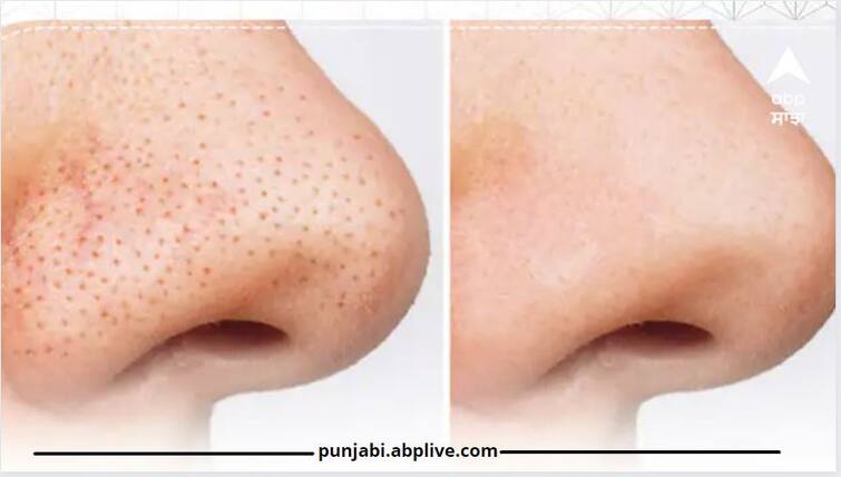 Blackheads Home Remedy: Home remedies to get rid of Blackheads ,Dark spots Blackheads Home Remedy: ਕਾਲੇ ਧੱਬੇ ਵਿਗਾੜ ਦਿੰਦੇ ਨੇ ਚਿਹਰੇ ਦੀ ਖੂਬਸੂਰਤੀ, ਇਹਨਾਂ ਨੂੰ ਜੜ੍ਹ ਤੋਂ ਖਤਮ ਕਰਨ ਲਈ ਅਪਣਾਓ ਇਹ ਨੁਸਖੇ