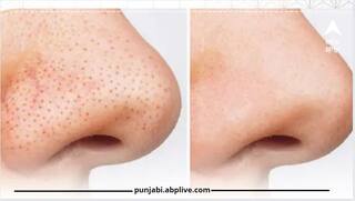 Blackheads Home Remedy: ਕਾਲੇ ਧੱਬੇ ਵਿਗਾੜ ਦਿੰਦੇ ਨੇ ਚਿਹਰੇ ਦੀ ਖੂਬਸੂਰਤੀ, ਇਹਨਾਂ ਨੂੰ ਜੜ੍ਹ ਤੋਂ ਖਤਮ ਕਰਨ ਲਈ ਅਪਣਾਓ ਇਹ ਨੁਸਖੇ