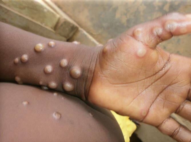 Monkeypox Virus found in Children first time in US Biden administration May impose public health Emergency Monkeypox : ਅਮਰੀਕਾ 'ਚ ਪਹਿਲੀ ਵਾਰ ਬੱਚਿਆਂ 'ਚ ਮਿਲਿਆ ਮੌਂਕੀਪੌਕਸ ਵਾਇਰਸ , ਬਿਡੇਨ ਪ੍ਰਸ਼ਾਸਨ ਲਗਾ ਸਕਦਾ ਪਬਲਿਕ ਹੈਲਥ ਐਮਰਜੈਂਸੀ