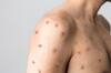 WHO Monkey Pox : ஆண்களுடன் பாலியல் உறவு கொள்ளும் ஆண்களால் குரங்கு அம்மை பரவுகிறதா? உலக சுகாதார அமைப்பு பதில்..