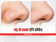 Blackheads Home Remedy: काले धब्बे बिगाड़ देते हैं चेहरे की खूबसूरती, इन्हें जड़ से खत्म करने के लिए आजमाएं ये घरेलू नुस्खे