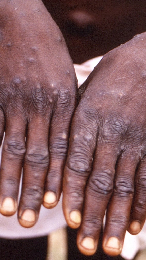 মাঙ্কিপক্স নিয়ে কেন বিশ্বজনীন জরুরী সতর্কতা 'হু'-র, দেখুন ছবি