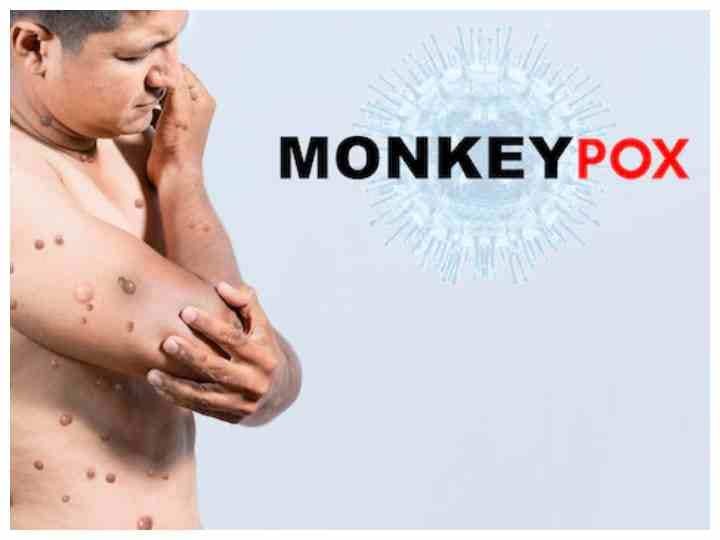 difference between monkeypox and chickenpox Monkeypox : चिकन पॉक्स से कैसे अलग है मंकीपॉक्स, एक्सपर्ट से जानें इनके बीच का अंतर