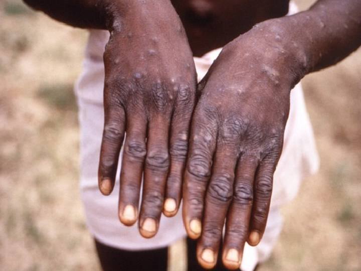 Monkeypox Cases India: வெளிநாடு செல்லாதவருக்கு குரங்கம்மை பாதிப்பு! கண்காணிப்பு பணிகள் தீவிரம்!!