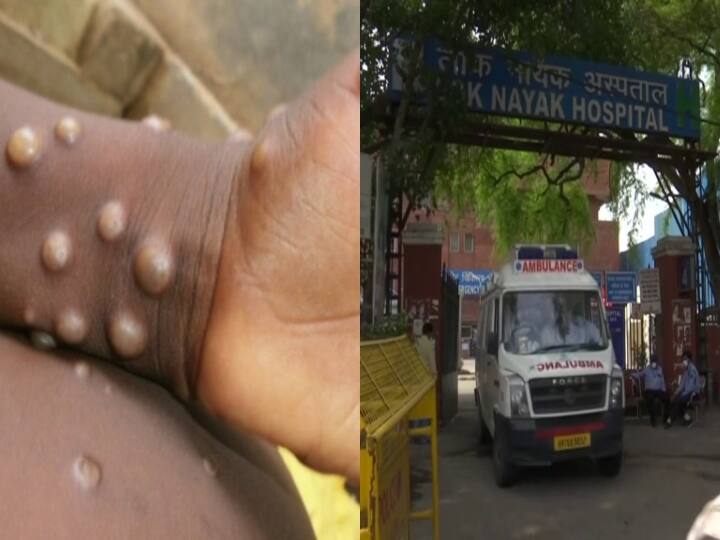 Monkeypox Detected in Delhi Patient Admitted in LNJP Islation Ward ANN Monkeypox: भारत में मंकीपॉक्स का चौथा मामला, दिल्ली में एक युवक के संक्रमित होने की पुष्टि, LNJP आइसोलेशन सेंटर में मरीज भर्ती