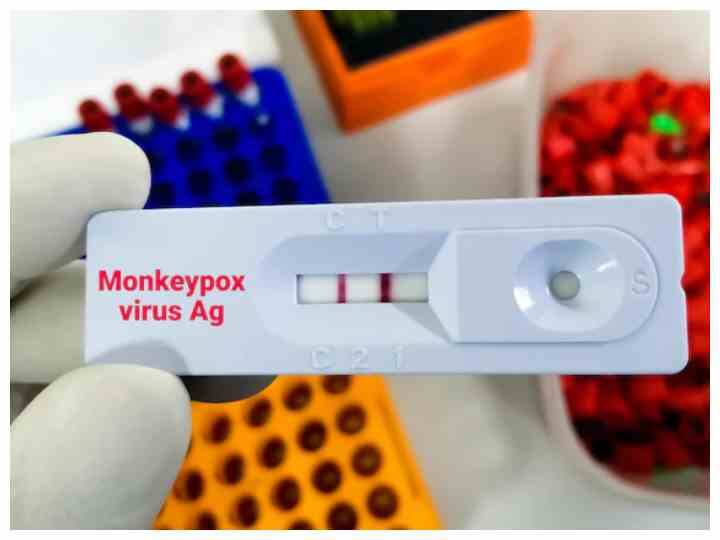 Monkeypox : क्या कोरोना की तरह ही एक व्यक्ति से दूसरे व्यक्ति में फैलता है मंकीपॉक्स Can monkeypox be spread between humans Monkeypox : क्या कोरोना की तरह ही एक व्यक्ति से दूसरे व्यक्ति में फैलता है मंकीपॉक्स