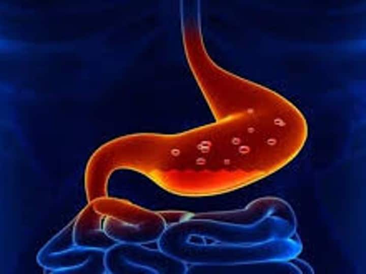ways to relieve acid reflux without medication Acid Reflux : நெஞ்சு எரிச்சல் பிரச்சனையா? சாதாரணமா எடுத்துக்காதீங்க.. உங்க டயட்டில் இதெல்லாம் இருக்கா?