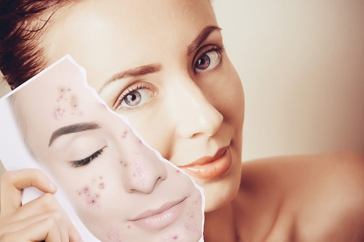How to cure pimples and acne best skin care products for acne prone skin Acne Cure: जिन्हें अक्सर कील-मुहासों की समस्या रहती है, वो ब्यूटी प्रॉडक्ट चुनते वक्त ये खास चीजें जरूर देखें