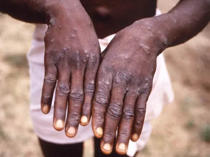 First Monkeypox Case In Delhi: Man With No History Of Foreign Travel Tests Positive For Virus