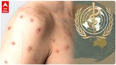 WHO Declares Health Emergency : కొవిడ్ సోకిన వ్యక్తిలో Monkeypox వైరస్ గుర్తింపు | ABP Desam