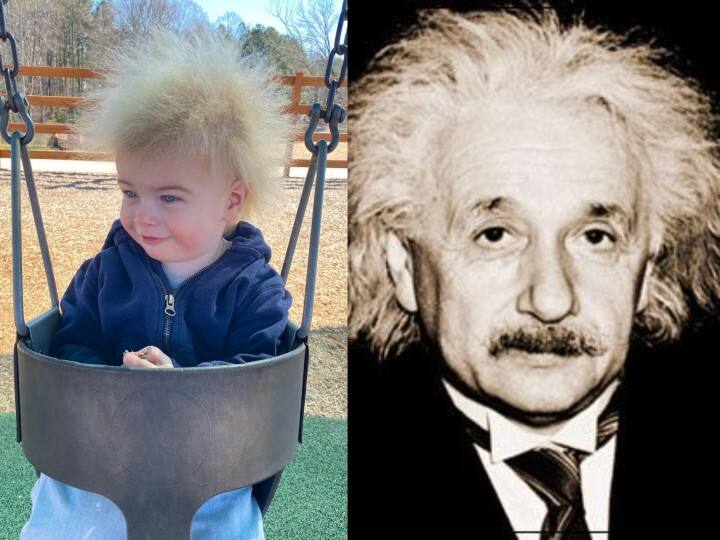 UHS A Rare Condition Leaves Babys Hair Look Like Albert Einstein மிக