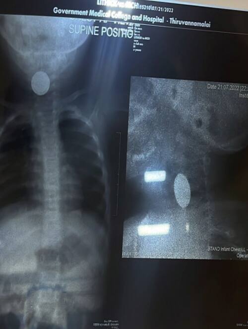 Doctors remove 2 year old child who swallowed battery cell without surgery 2 வயது குழந்தையின் தொண்டையில் சிக்கிய ரிமோட் கார் பேட்டரி: அறுவை சிகிச்சை இன்றி அகற்றிய மருத்துவர்கள்