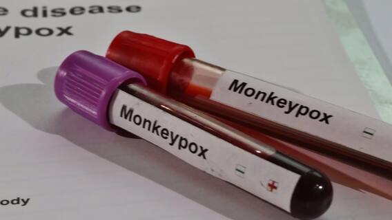 Monkeypox Suspect Case in Kamareddy : కువైట్ నుంచి వచ్చిన ఓవ్యక్తిలో లక్షణాలు గుర్తింపు | ABP Desam
