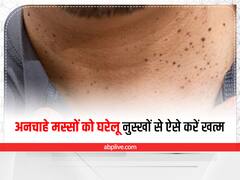 Home Remedies: चेहरे के अनचाहे मस्सों से हो गए हैं परेशान, घर बैठे अपनाएं ये फैंटास्टिक उपाय
