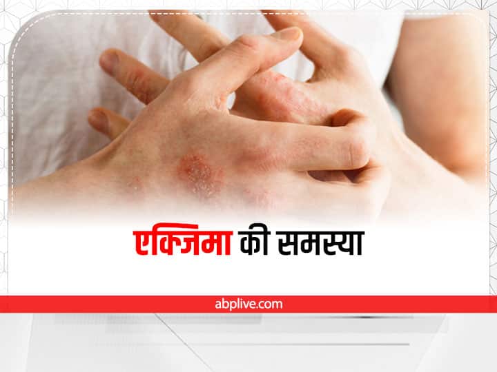 Eczema Skin Care Eczema Prevention Tips monsoon skin allergy cure tips Eczema Skin Care: इन कारणों से फैलता है एक्जिमा, देखें त्वचा संबंधी बीमारी की मुख्य वजह