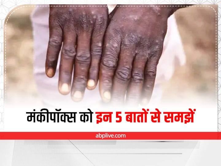 Monkeypox Case In India Monkeypox Case In Delhi Monkeypox Symptoms Cause And Treatment Monkeypox: फैल रहा है मंकीपॉक्स, विदेश यात्रा से आए हैं तो रहें सावधान! मंकीपॉक्स को इन 5 बातों से समझें
