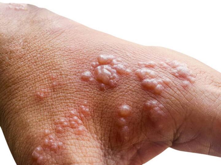 How to differentiate between monkeypox and smallpox? What do the experts say? Monkeypox vs smallpox: మంకీపాక్స్ - స్మాల్ పాక్స్ మధ్య తేడాను కనిపెట్టడం ఎలా? నిపుణులు ఏమంటున్నారు?