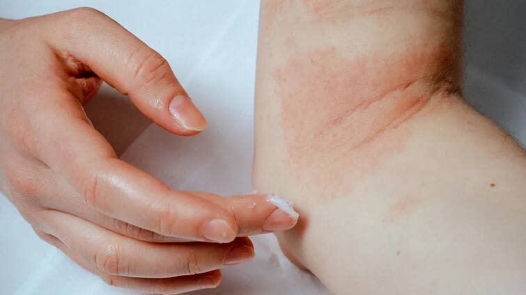 Eczema Skin Care: Because of these reasons you are a victim of eczema, know the main cause of skin diseases Eczema Skin Care : ਇਨ੍ਹਾਂ ਕਾਰਨਾਂ ਕਰਕੇ ਤੁਸੀਂ ਹੁੰਦੇ ਹੋ ਐਕਜ਼ੀਮਾ (ਚੰਬਲ) ਦੇ ਸ਼ਿਕਾਰ, ਜਾਣੋ ਚਮੜੀ ਸੰਬੰਧੀ ਬਿਮਾਰੀਆਂ ਦਾ ਮੁੱਖ ਕਾਰਨ