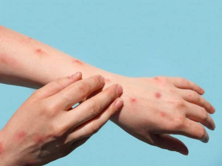 Monkeypox: Study Finds 3 New Severe Symptoms To Watch Out For Monkey Pox : பகீர் செய்தி.. குரங்கு அம்மைக்கு மேலும் மூன்று தீவிர அறிகுறிகள்.. ஆராய்ச்சியாளர்கள் வெளியிட்ட தகவல்..