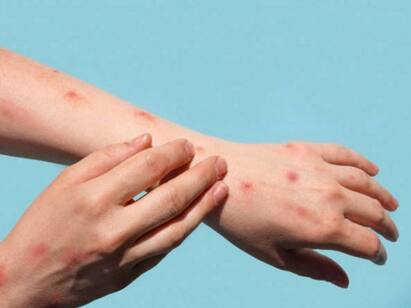 Monkeypox: Study Finds 3 New Severe Symptoms To Watch Out For Monkey Pox : பகீர் செய்தி.. குரங்கு அம்மைக்கு மேலும் மூன்று தீவிர அறிகுறிகள்.. ஆராய்ச்சியாளர்கள் வெளியிட்ட தகவல்..