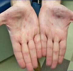 Explained : ਮੰਕੀਪੌਕਸ ਹੈਲਥ ਐਮਰਜੈਂਸੀ ਪਰ ਇਹ ਕੋਰੋਨਾ ਜਿੰਨਾ ਖ਼ਤਰਨਾਕ ਕਿਉਂ ਨਹੀਂ, ਇੰਨ੍ਹਾਂ 5 ਪੁਆਇੰਟਾਂ 'ਚ ਸਮਝੋ