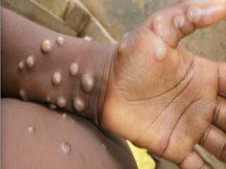 Monkeypox Guidelines: 21 દિવસનું આઇસોલેશન, મંકીપૉક્સ માટે સરકારે જાહેર કરી ગાઇડલાઇન્સ